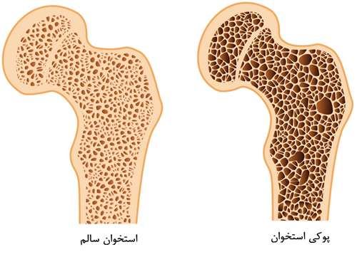 برای مقابله با پوکی استخوان چه کنیم؟