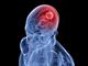 استفاده از نانوذرات برای از بین بردن سلول‌های سرطانی مغز